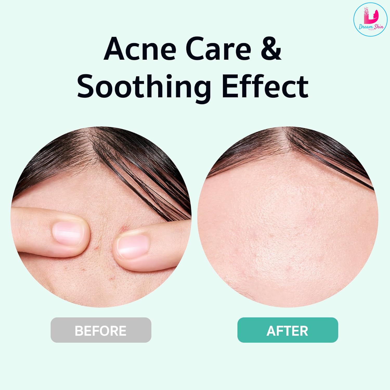 BRING GREEN Zinc Teca Blemish Serum [25ml]